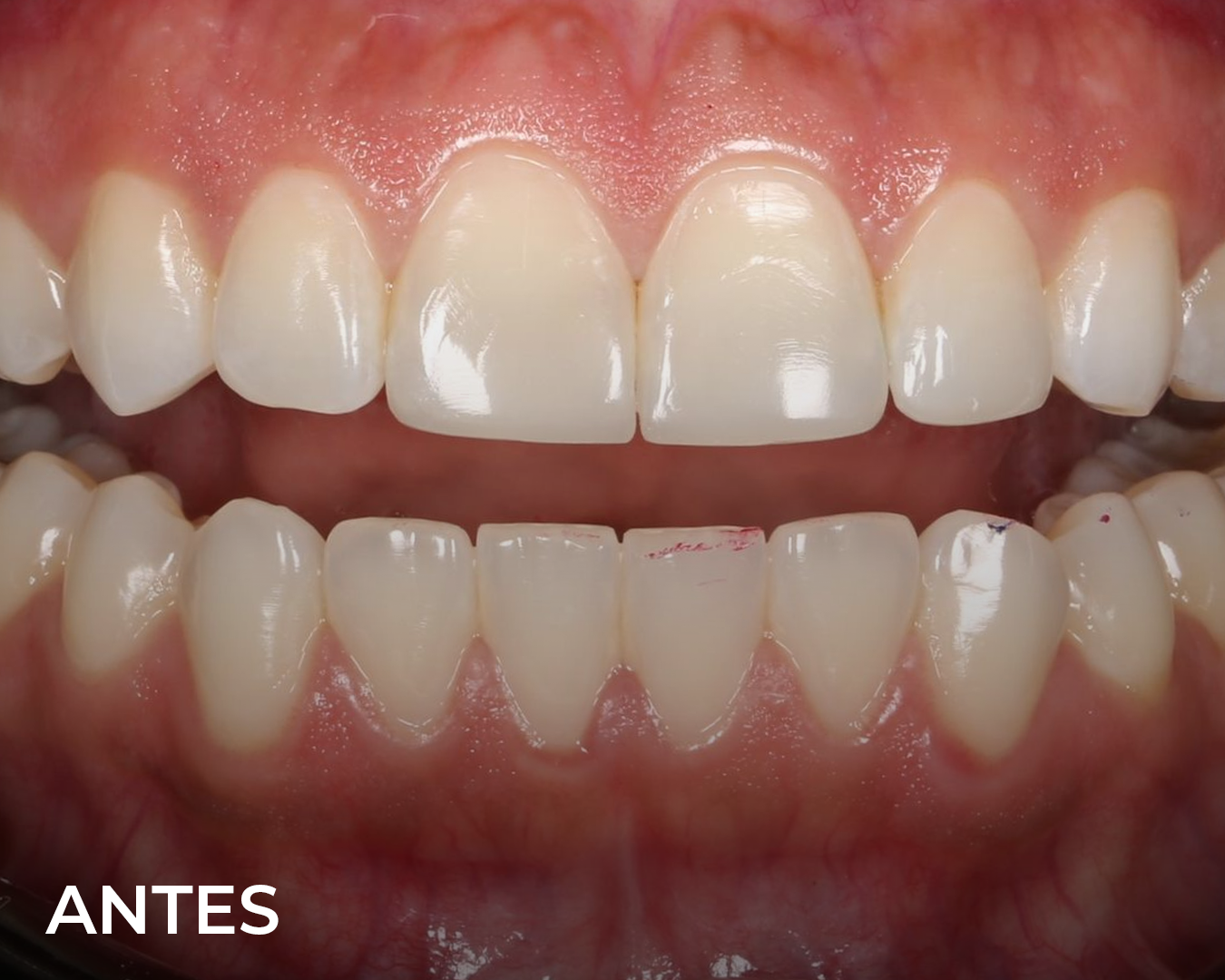 carillas_resina_antes