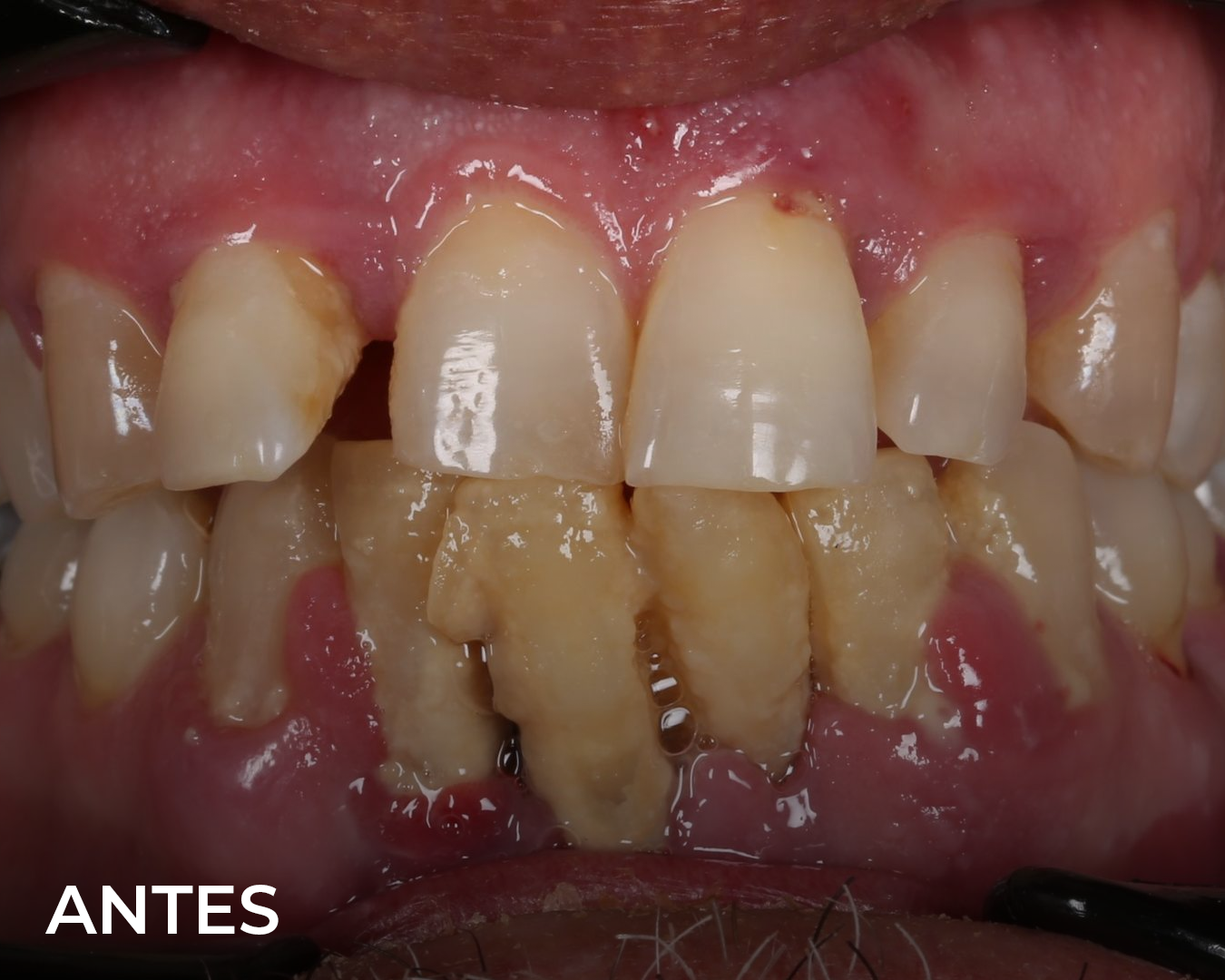 implantes_dentales_antes