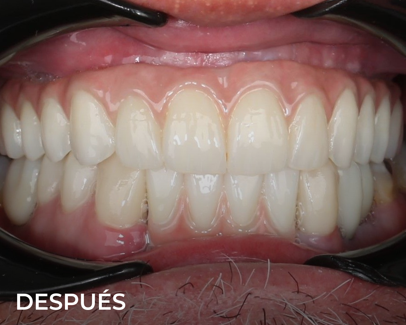 implantes_dentales_despues