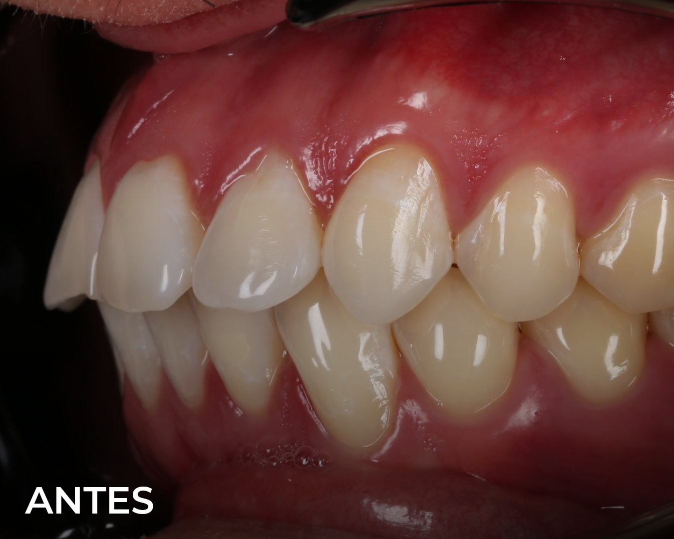 o_brackets_antes