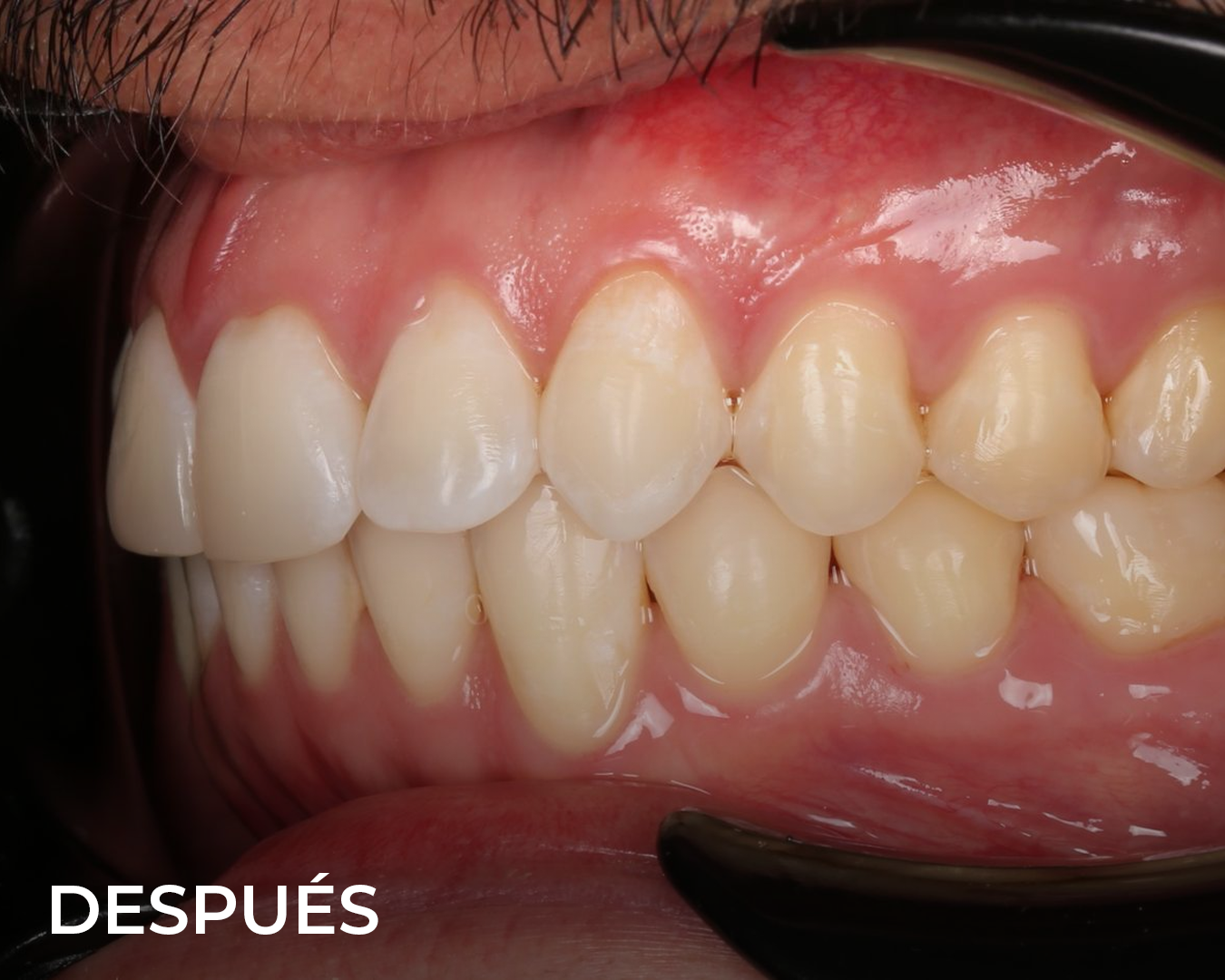 o_brackets_despues