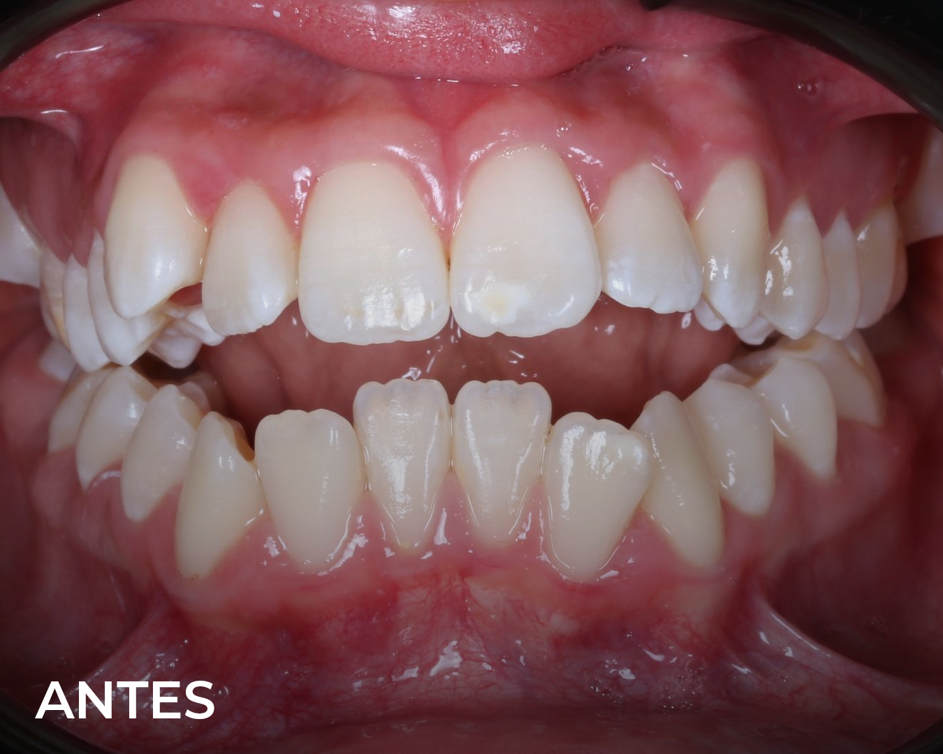 o_invisible_antes