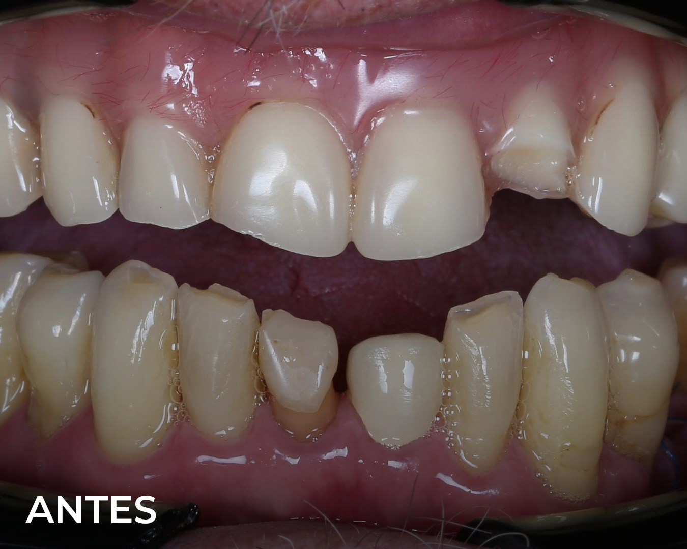 protesis_hibrida_antes